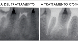 devitalizzazione dente